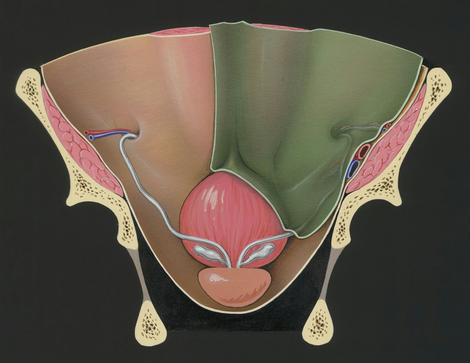 Understanding Benign Prostatic Hyperplasia (BPH): A Common Condition in Men